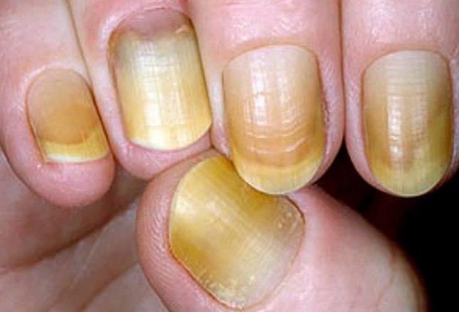 Yellow nail syndrome 