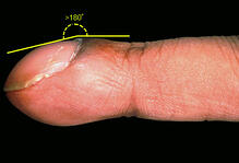 Nail clubbing is a serious condition.  Check you nails for this.