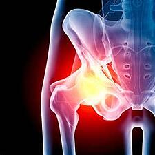 Is your hip on fire? Prolozone therapy works immediately and might save you from surgery - Second Nature Care 