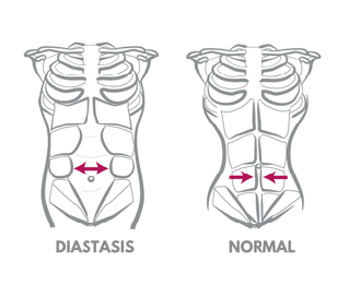 Diastisis Belly