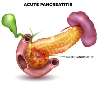 bigstock-Pancreatitis-Illustration-Inf-161322932.jpg