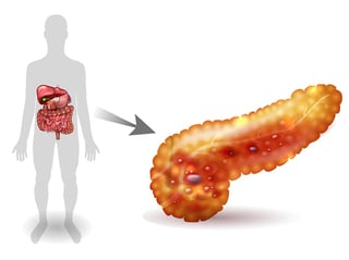 bigstock-Pancreatitis-Illustration-Inf-161324270.jpg