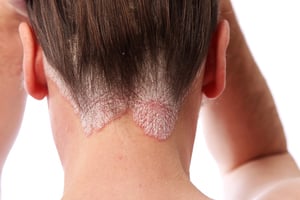 bigstock-Psoriasis-On-The-Hairline-And--6556784.jpg