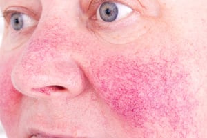 bigstock-Rosacea-Facial-Skin-Disorder--204242509