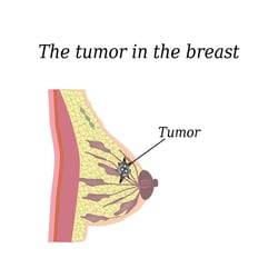 Breast Cancer Awareness Do you know Breast Cancer? Take the Breast Cancer Quiz
