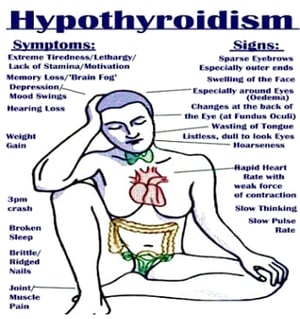 hypothyroid - This Photo by Unknown Author is licensed under CC BY-SA-NC