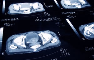 prostate - This Photo by Unknown Author is licensed under CC BY-NC